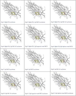 Computer Modeling of Clot Retrieval—Circle of Willis